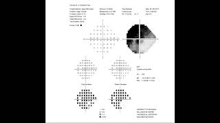 RS Visual Fields Part 2 Interpreting The Test Results [upl. by Ssur]