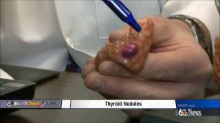 Thyroid Nodules [upl. by Wivestad731]