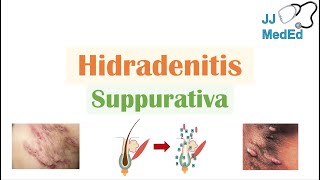 Hidradenitis Suppurativa HS  Pathophysiology Triggers Signs amp Symptoms Diagnosis Treatment [upl. by Scheider]