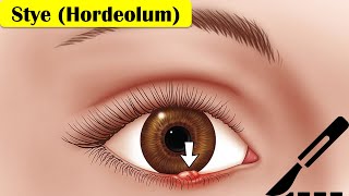 Stye Hordeolum  Causes Pathogenesis Signs amp Symptoms And Treatment [upl. by Eissel]