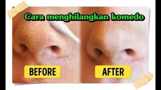 Cara Menghilangkan komedo hitam di hidung [upl. by Montague]