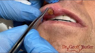 Removal of a pyogenic granuloma on the lip [upl. by Pasahow]