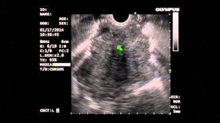 Diagnosis of Thymoma by EUS FNA  Bronte Holt [upl. by Eladroc]