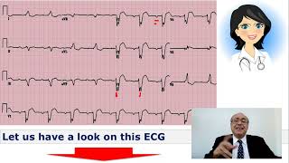 EKG Trainer Case 3 Answer [upl. by Cita366]