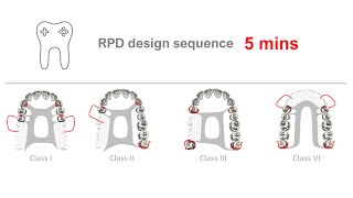 RPD Design in 5 mins [upl. by Enelear]