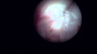 Arthroscopy of the Jaw Temporomandibular Joint TMJ  Part 1 [upl. by Anelliw]