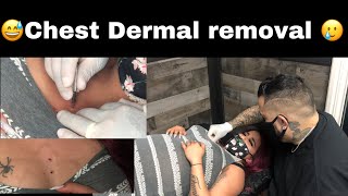 Chest Dermal Removal 🥲 [upl. by Prissy215]