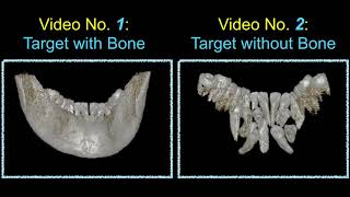 Innovative Impaction Treatment in AAO 2018 Part 6｜【Chris Chang Ortho】CC467 [upl. by Essa]