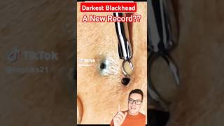 Darkest Ever BLACKHEAD REMOVAL  Shocking shorts [upl. by Barret]