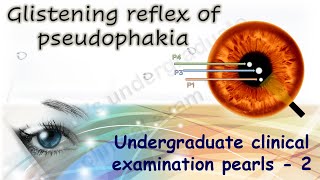 Glistening reflex in pseudophakia Undergraduate Clinical Examination Pearls 2 [upl. by Lenzi]