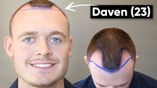 Geheimratsecken mit 23 Jahren  Davens Haartransplantation im Memorial [upl. by Araf]