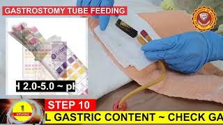 GASTROSTOMY TUBE FEEDING [upl. by Ted]