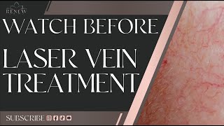 What To Expect  Excel V Laser Vein Treatment  Instantly Remove Spider Veins [upl. by Anirrok]