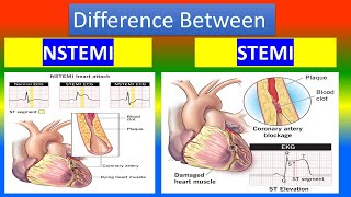 Contrast between NSTEMI and STEMI [upl. by Octavius858]