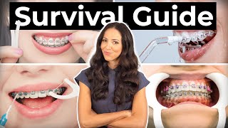 How To Prepare amp What To Expect With BRACES [upl. by Shelley563]