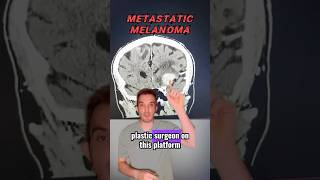 A sad case of metastatic melanoma [upl. by Mikihisa]