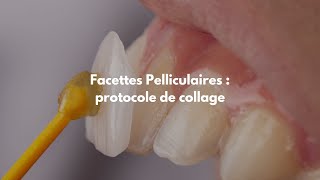 Facette dentaire Vs Orthodontie  Guide complet  partie 5 [upl. by Dolora]