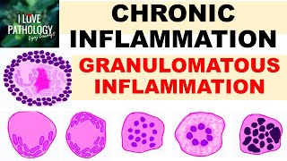 INFLAMMATION Part 9 Chronic Inflammation  GRANULOMATOUS INFLAMMATION [upl. by Laemaj]