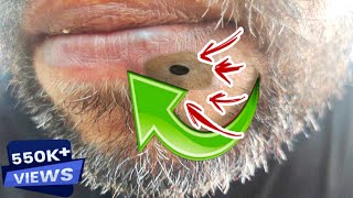 Super Satisfying Blackhead Removal2023best Blackhead RemovalBlackhead Removal [upl. by Denver]