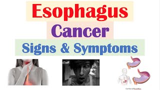 Esophageal Cancer Signs amp Symptoms amp Why They Occur [upl. by Nuhsar]