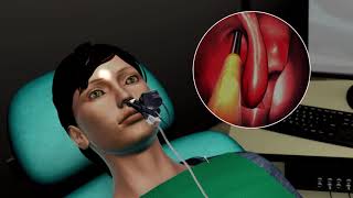 Balloon Sinus Surgery Animation [upl. by Hgeilhsa]