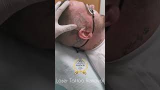 Laser Tattoo Removal Near the Ear reverenttattoo [upl. by Dorinda352]