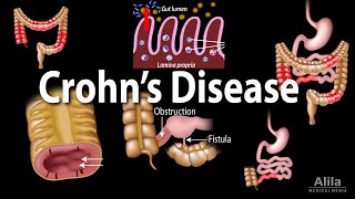 Crohns Disease Pathophysiology Symptoms Risk factors Diagnosis and Treatments Animation [upl. by Sondra]