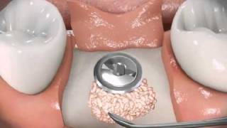 Implant  Bone graft for implant [upl. by Alaunnoif]