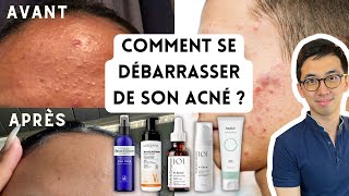 PEAU SANS ACNÉ  BOUTONS BLANCS OU ROUGES MICROKYSTES PLAQUES DE BOUTONS PAPULES PUSTULES [upl. by Nonie]