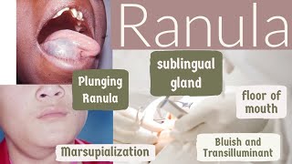 RanulaGeneral Surgery for Dental StudentsBibliodent [upl. by Landahl]