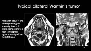 Radiology  Salivary Glands Imaging  Head and Neck [upl. by Reivaxe]