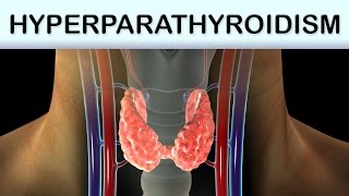 Hyperparathyroidism Medical Animation [upl. by Anabahs]