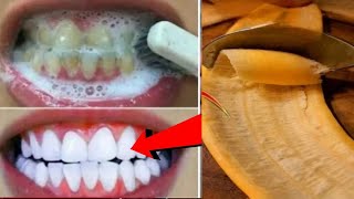 In Just 2minutes Whiten Yellow stained Teeth at Home BEST TEETH WHITENING REMEDY ll NGWorld [upl. by Clarisse]