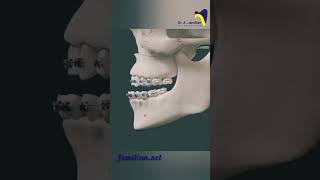 Le Fort I osteotomy for maxillary advancement dentistOsteotomy orthodontistMaxillaryAdvancement [upl. by Jessi]