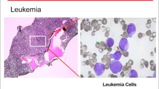 Helping Kids Understand Bone Marrow Failure Syndromes [upl. by Marsh980]