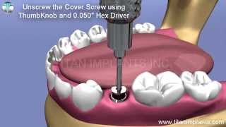 Restore TG Hex Abutment for Screw Retained Crown [upl. by Akilak]