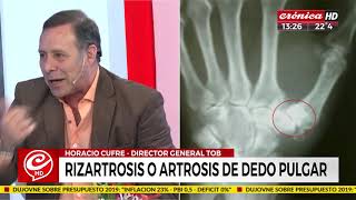 ¿Qué es la rizartrosis o la artrosis en el dedo pulgar [upl. by Caras]