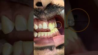 Magic of Scaling Polishing ❤️ dentistaentiktok dentistteeth teethwhiting [upl. by Leatri]