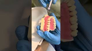 PFM Preparation on tooth 14 for Veneered Restorations Part 1 [upl. by Maressa]