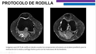 Protocolo de Rodilla [upl. by Nod]