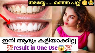 ഇനി ആരും കളിയാക്കില്ല 💯💯 teeth whitening home remedies in malayalam  teeth whitening naturally [upl. by Atsuj]