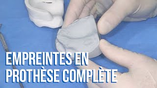 👍 Comment réussir ses empreintes secondaires en prothèse complète [upl. by Ecela]