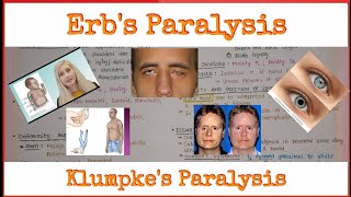 Brachial Plexus 33  Erbs Paralysis  Klumpkes Paralysis  Clinical Anatomy of Brachial Plexus [upl. by Eirelam]