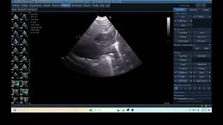 IQ 290 TFAST LUNG MASS ULTRASOUND ICP CPP ECHOPAC ANALYSIS 00 [upl. by Memory]