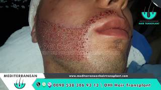 DHI Beard Transplant  DHI Moustache Transplant  DHI Hair Transplant TURKEY [upl. by Mikah]