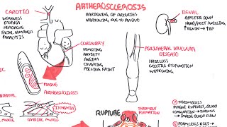 Cardiomyopathy Overview  types dilated hypertrophic restrictive pathophysiology and treatment [upl. by Knitter959]