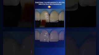 Diastema y Alargamiento Incisal carillasdirectas [upl. by Adine]