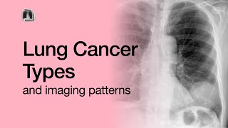 Lung Cancer Types [upl. by Johen]