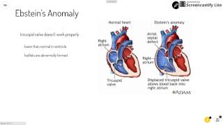 Ebsteins Anomaly [upl. by Merkley]