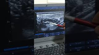 Ascaris lumrbricoid by ultrasound ثالث حاله إسكارس بالسونار [upl. by Ruckman]